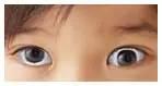 小兒斜視什么時(shí)候做最好？