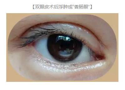 雙眼皮術(shù)后出現(xiàn)上瞼下垂怎么辦？