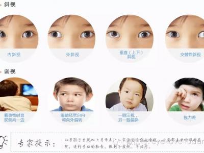 孩子斜弱視治療，不要錯過關鍵時機