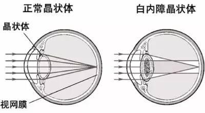 你不得不知的白內障幾大問題