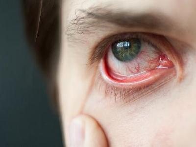 角膜炎口服什么藥好