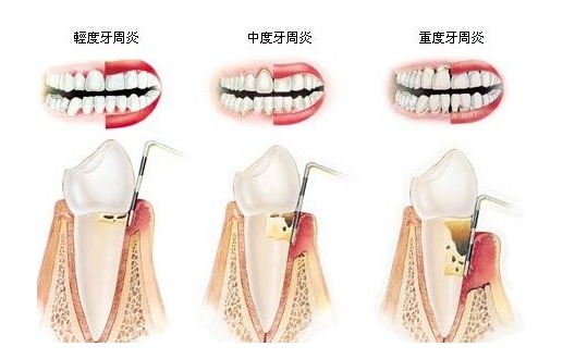 為什么會有牙周病？牙周病的中醫治療和保養方法