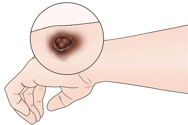 褥瘡外用藥有哪些