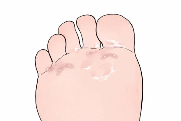 腳上長水泡是濕氣重嗎 出水泡是排濕現象嗎-易網<a href=http://www.aoa7937.com/ target=_blank class=infotextkey>健康養生</a>網 腳上長水泡是濕氣重嗎 出水泡是排濕現象嗎