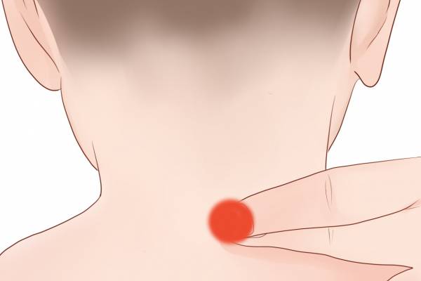 針灸按摩大椎穴的好處 針灸大椎穴有危險嗎