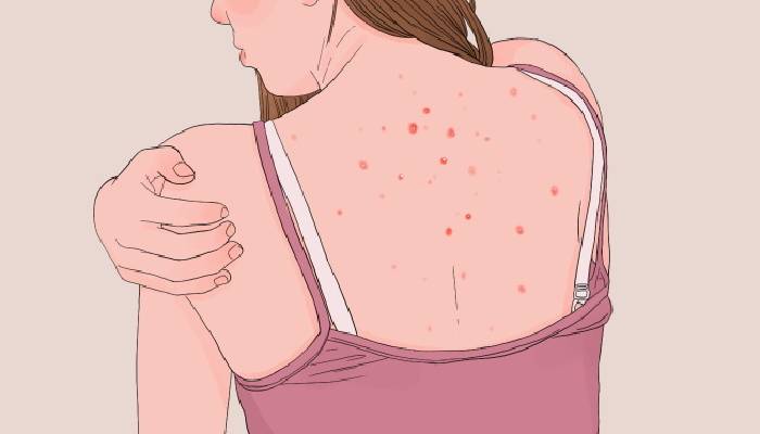 濕氣重按什么穴位 濕氣重可以怎么調理