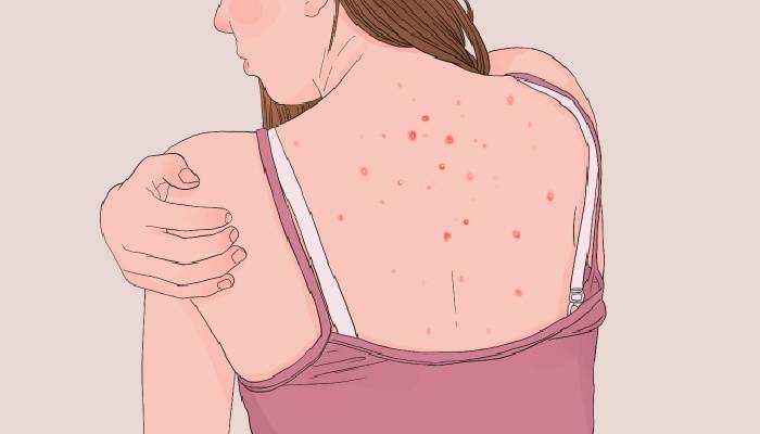 去除體內濕氣的穴位 體內濕氣重怎么辦