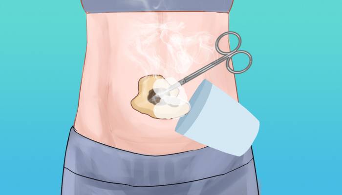 來月經可以艾灸肚子嗎 例假期艾灸會不會止血