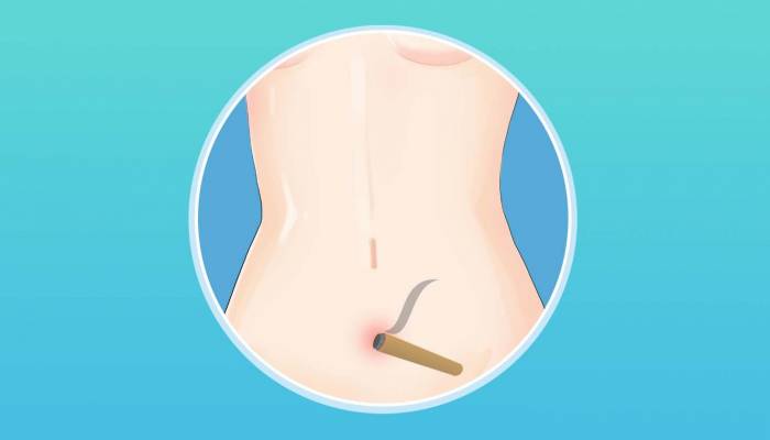 艾灸肚臍眼多久一次最佳 肚臍眼可以艾灸嗎