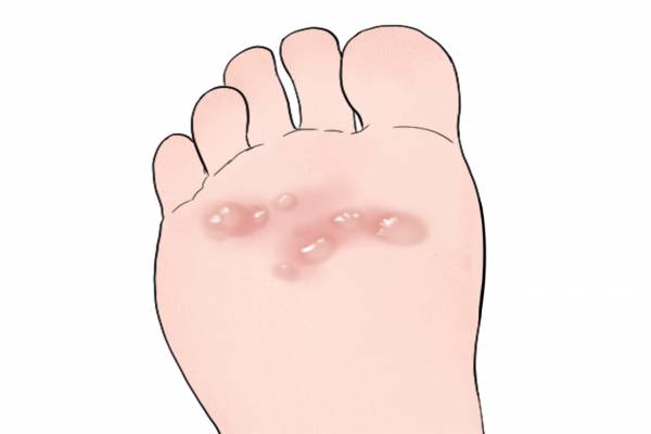 腳上長水泡是濕氣重嗎 出水泡是排濕現象嗎-易網健康<a href=http://www.aoa7937.com/jkys/ target=_blank class=infotextkey>養生</a>網 腳上長水泡是濕氣重嗎 出水泡是排濕現象嗎