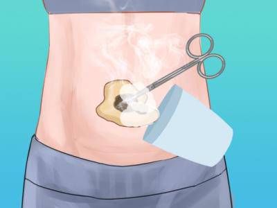 來月經可以艾灸肚子嗎 例假期艾灸會不會止血