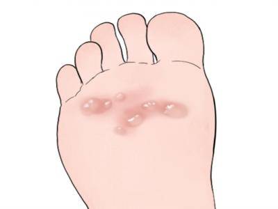 腳上長水泡是濕氣重嗎 出水泡是排濕現(xiàn)象嗎